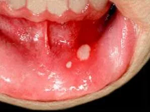 Лечение стоматита во рту