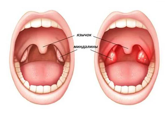 Причины воспаления челюстных лимфоузлов