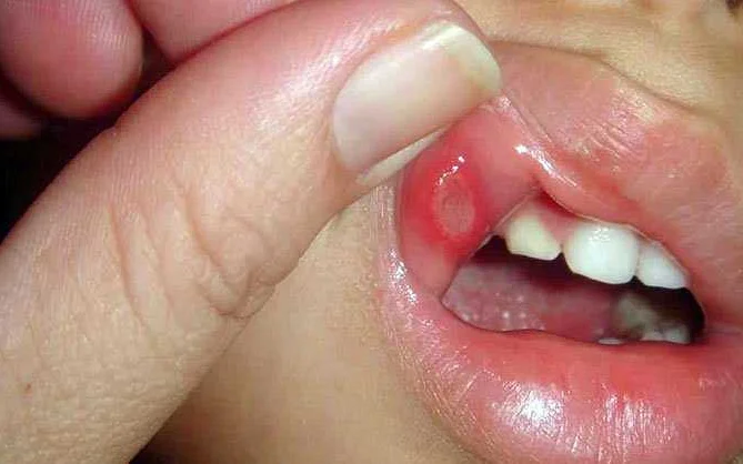 Вирусы и грибки: лечение во рту