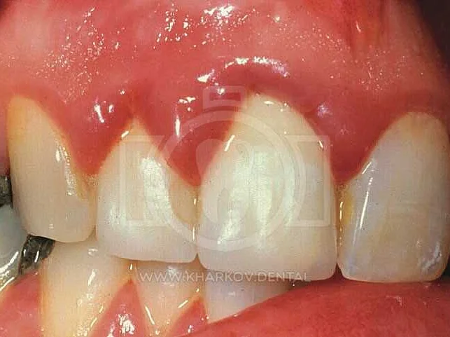 Эффективные способы укрепления десен и зубов в домашних условиях