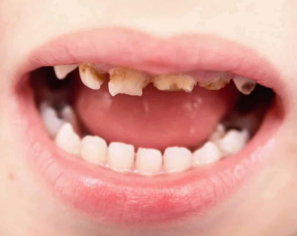 Советы по укреплению зубов у младенца