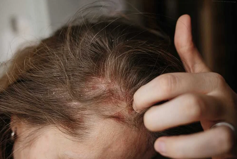 Причины чесания головы и выпадения волос