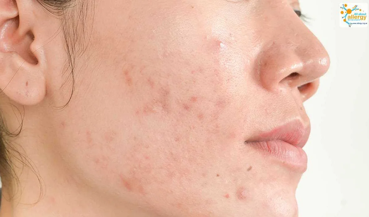 Как предотвратить появление сыпи на лице?
