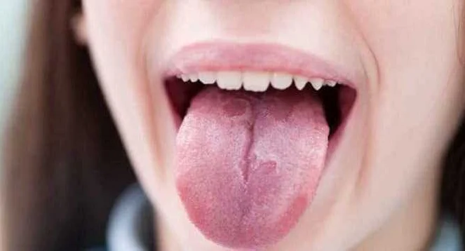 Диагностика чувства жжения во рту и на языке