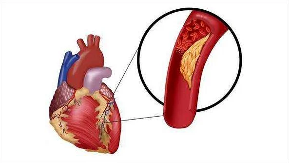 Ишемическая болезнь сердца: профилактика и диагностика