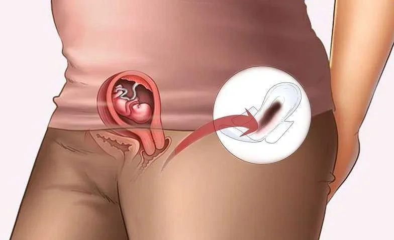Лечение коричневатых выделений в начале беременности