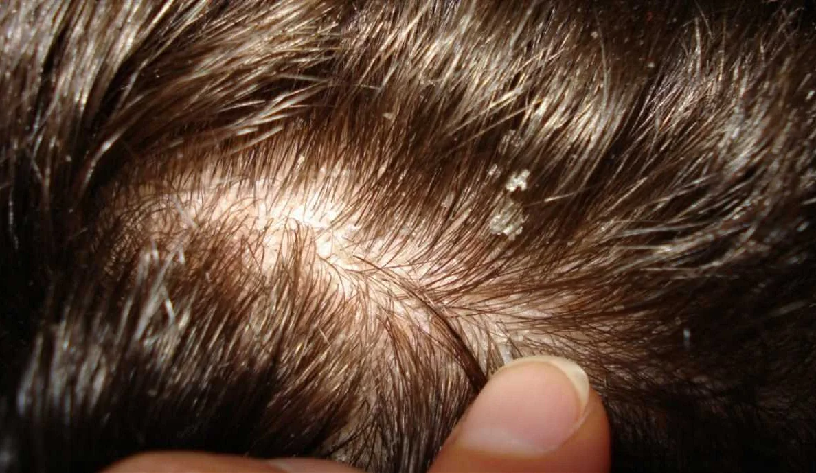 Псориаз и экзема на волосистой части головы