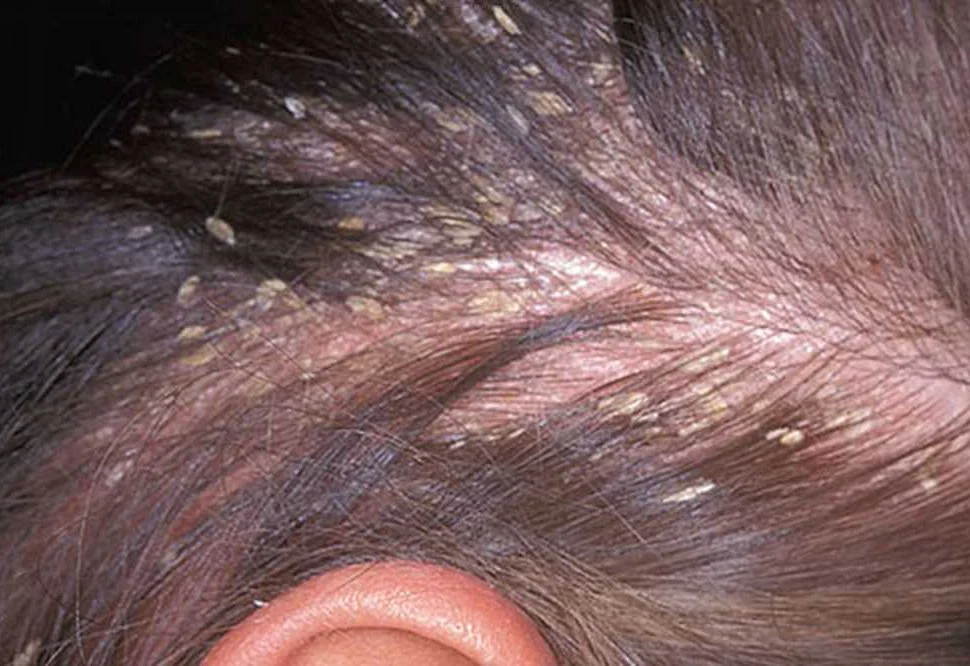 Аллергические реакции и кожные заболевания головы