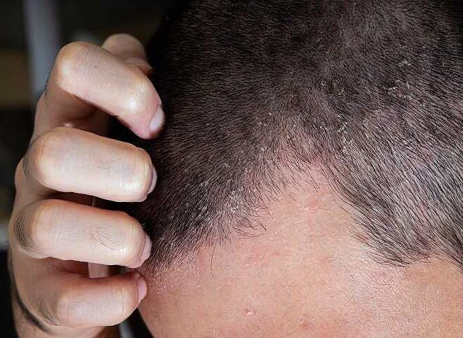 Лечение кожных заболеваний волосистой части головы