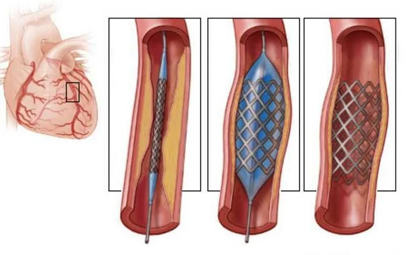 Шунтирование коронарных артерий: суть и результаты