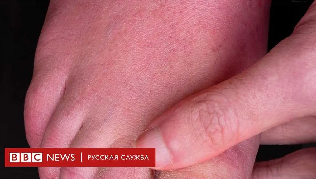 Симптомы шелушения кончиков пальцев рук