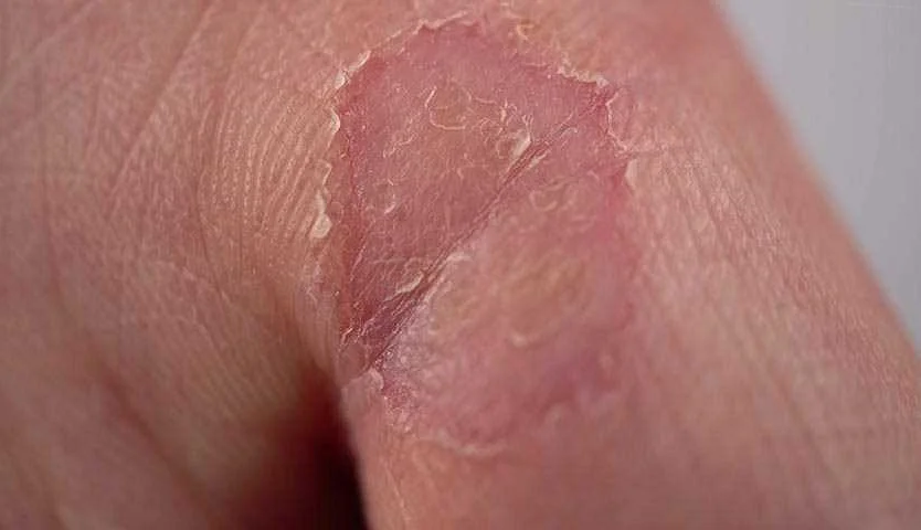 Симптомы шелушения кожи на правой кисти: