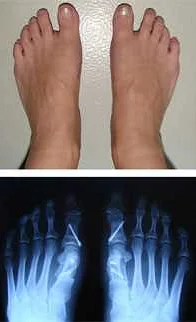 Лечение шишки на ноге около колена