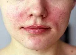 Сыпь у взрослых: возможные причины и симптомы