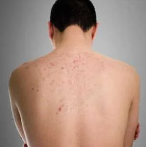 Симптомы сыпи на спине и лице