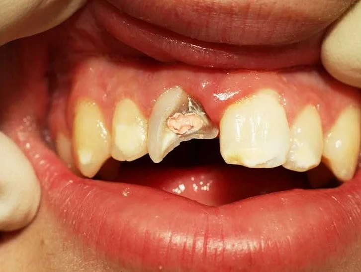 Что делать, если сломался зуб у взрослого