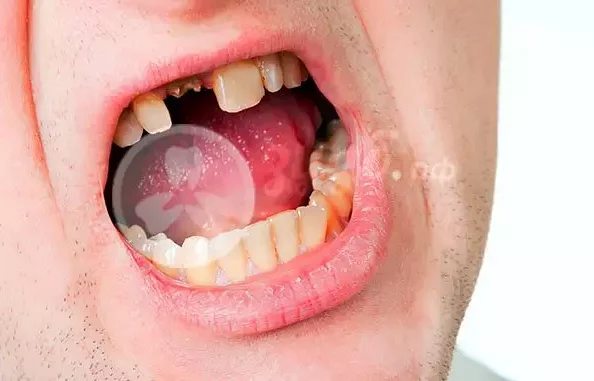Причины сломанного зуба