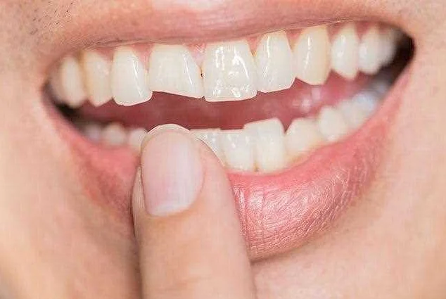 Советы по уходу за сломанным зубом