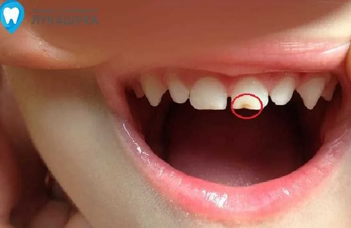 Профилактика сломанного зуба