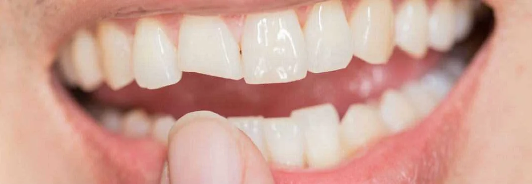 Симптомы сломанного зуба