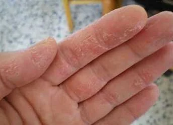 Роль внешних факторов в появлении трещин между пальцами рук