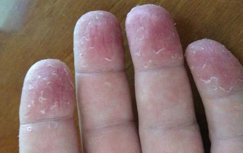 Инфекция как причина трещин между пальцами рук