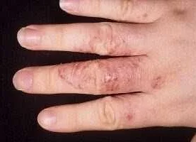 Симптомы трещин между пальцами рук