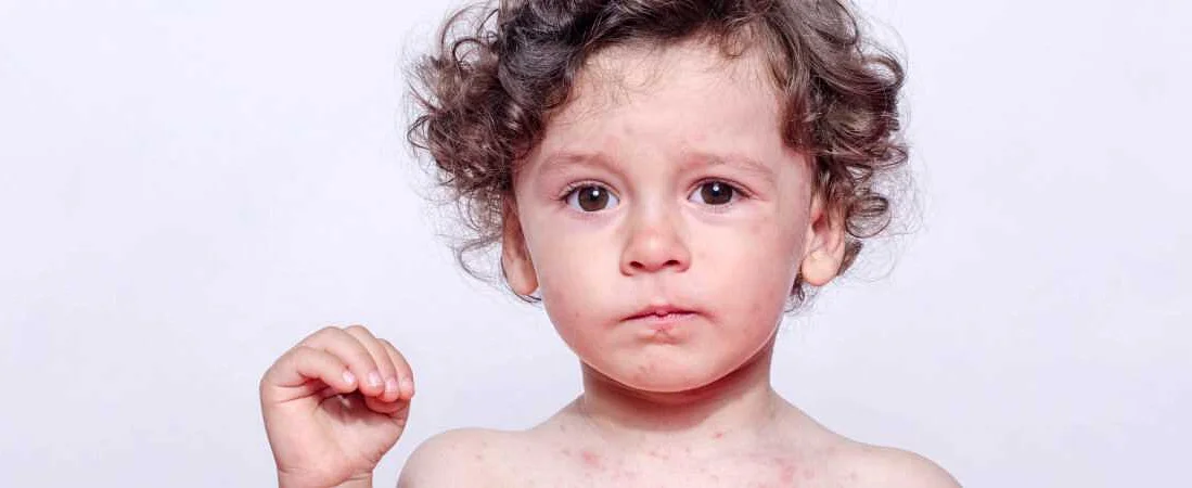 Инфекционные заболевания и сыпь у ребенка