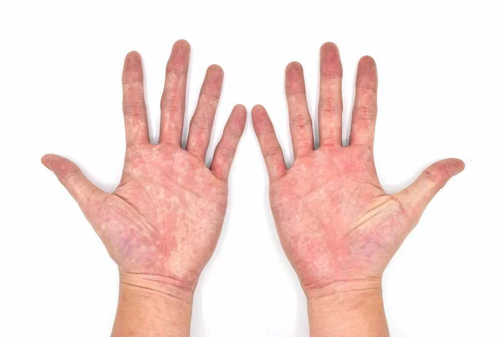 Почему руки краснеют: причины и способы устранения