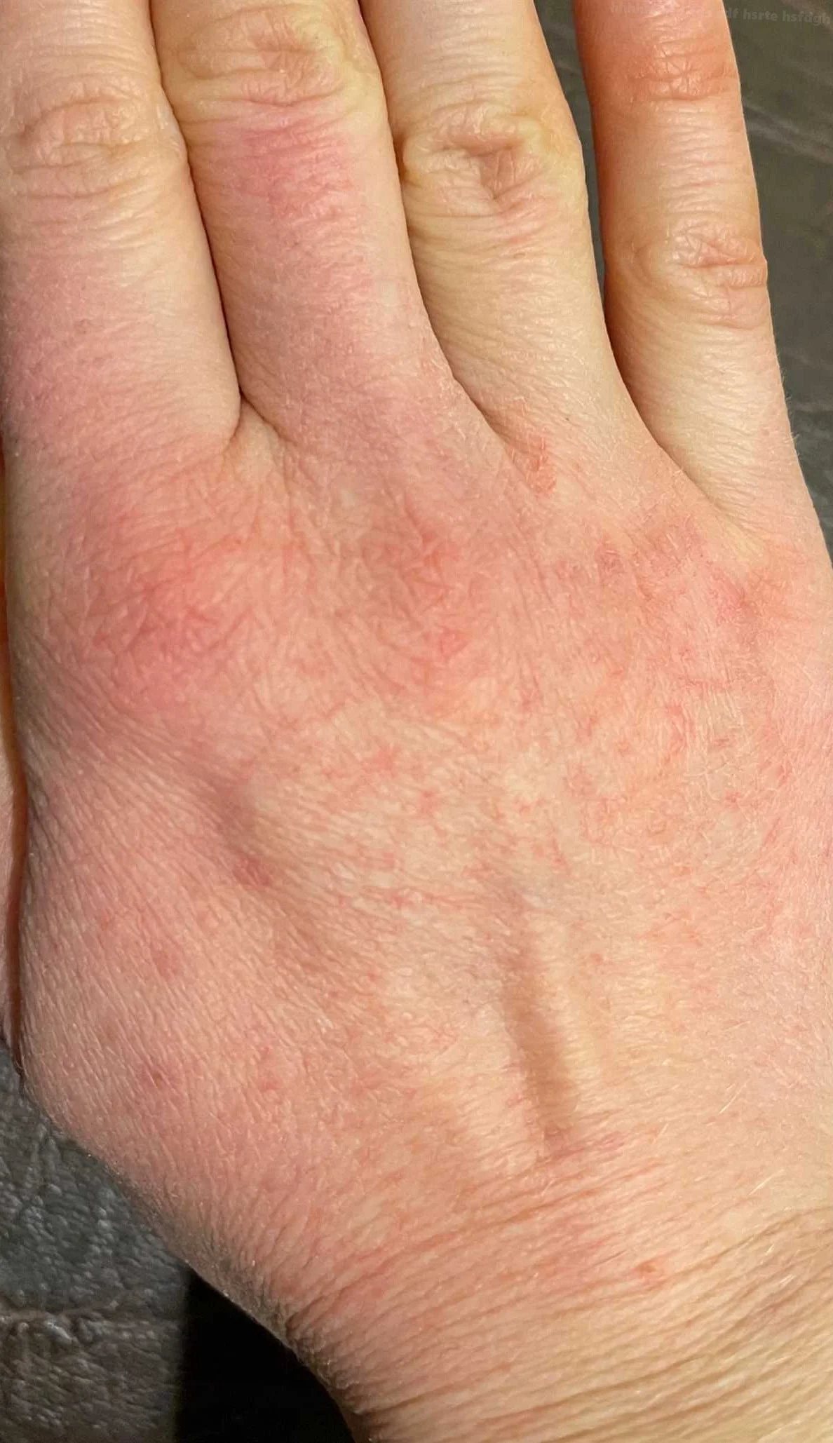 Причины возникновения язвочек на коже рук