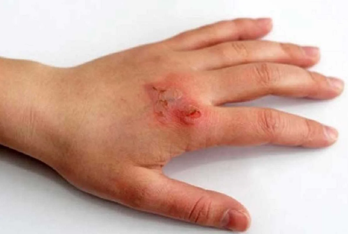 Влияние внешних факторов на язвочки на коже рук