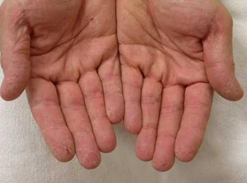 Диагностика и обследование при язвочках на коже рук