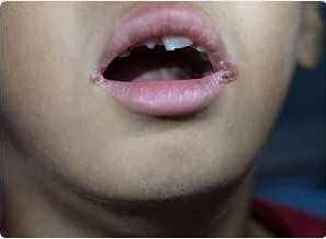 Нарушение микрофлоры рта